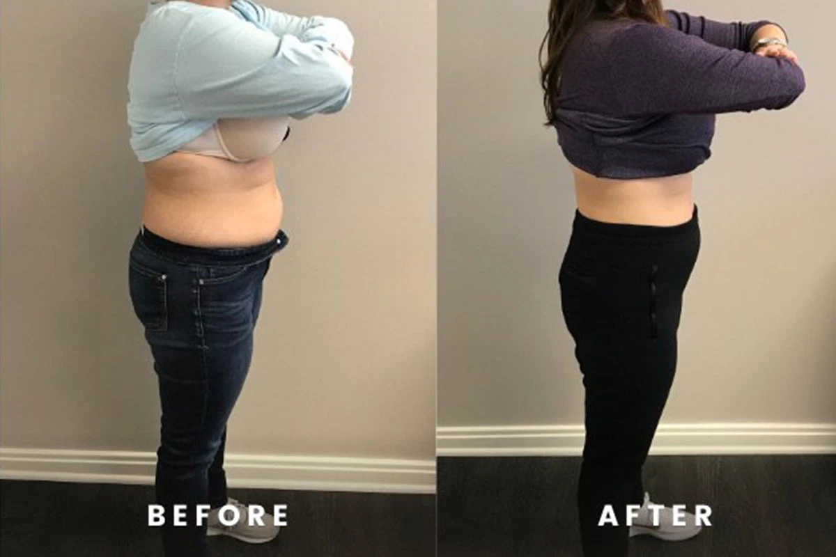 weight loss injections before and after