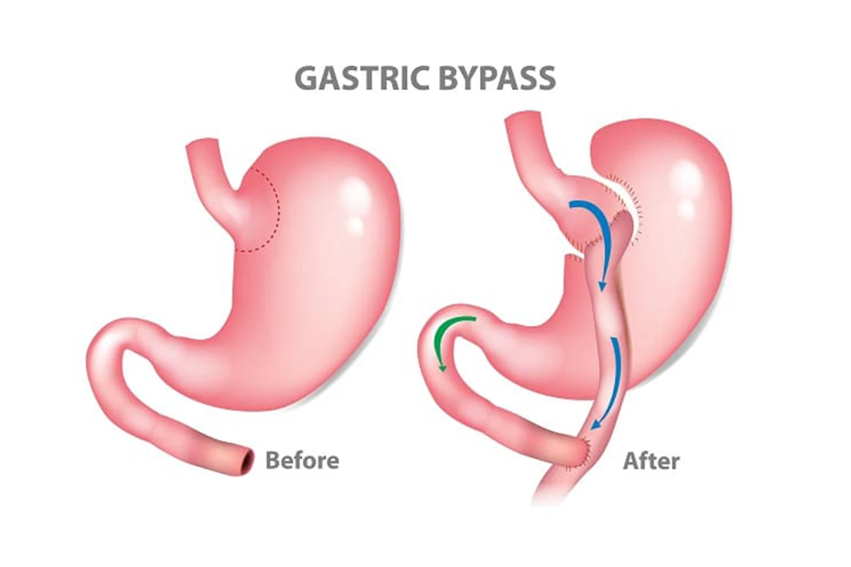Gastric Bypass (Roux-en-Y)