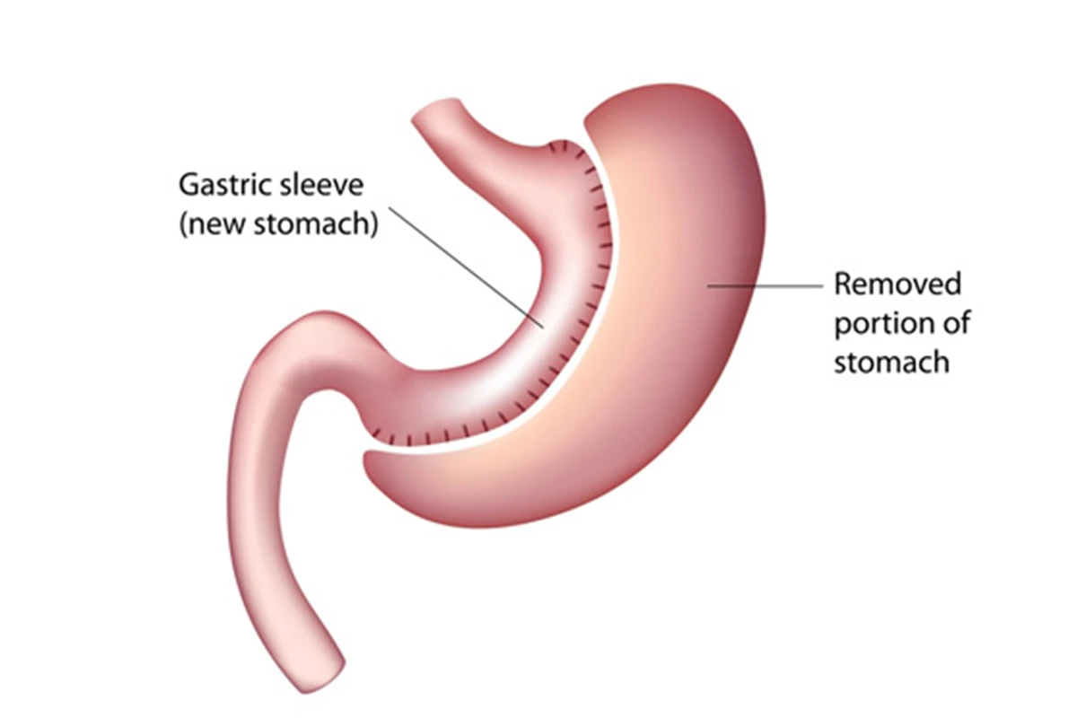 Gastric Sleeve (Sleeve Gastrectomy)