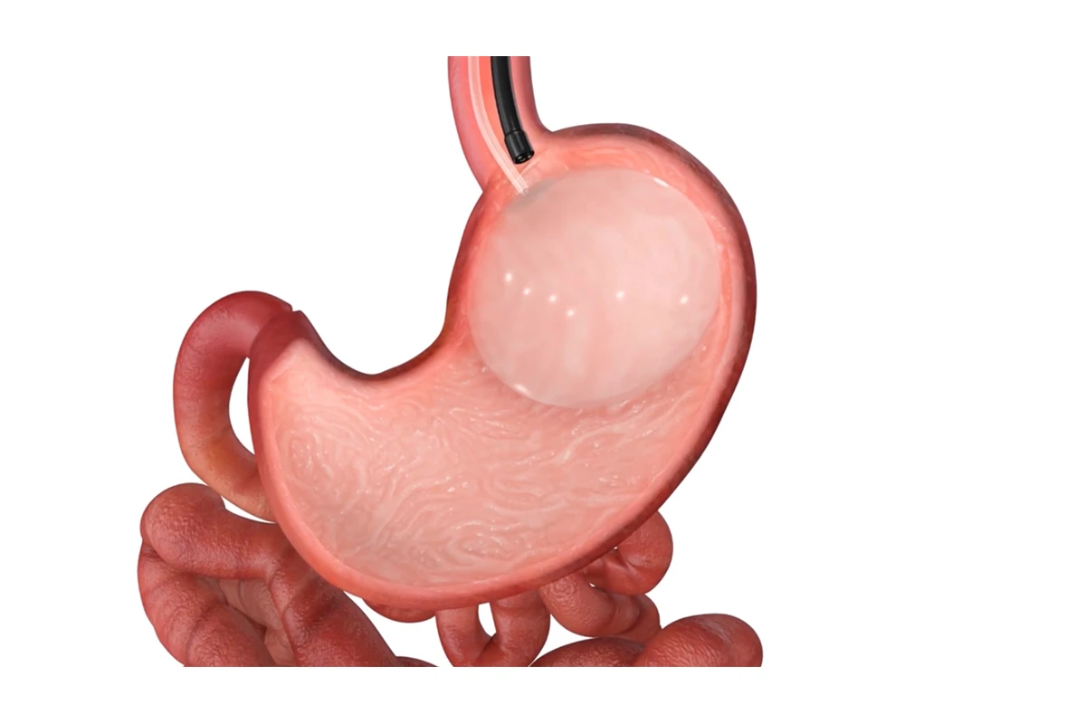 Intragastric Balloon
