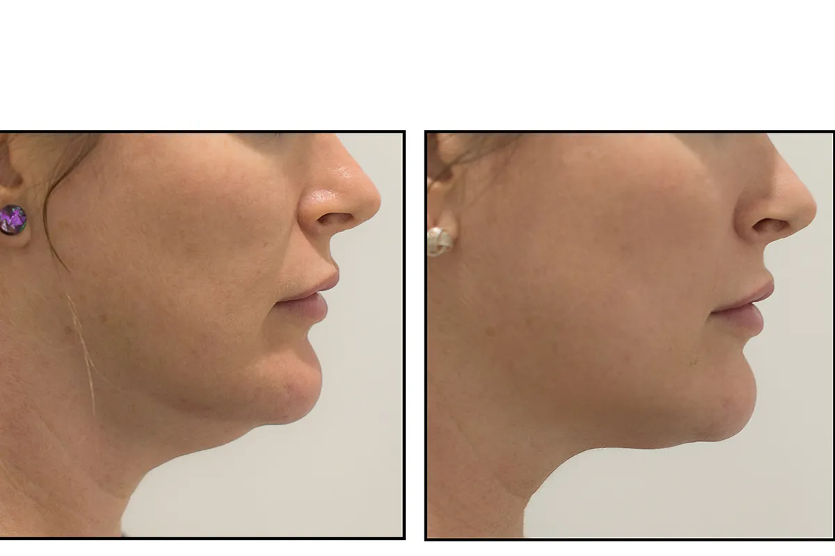 Fat Dissolving Injections