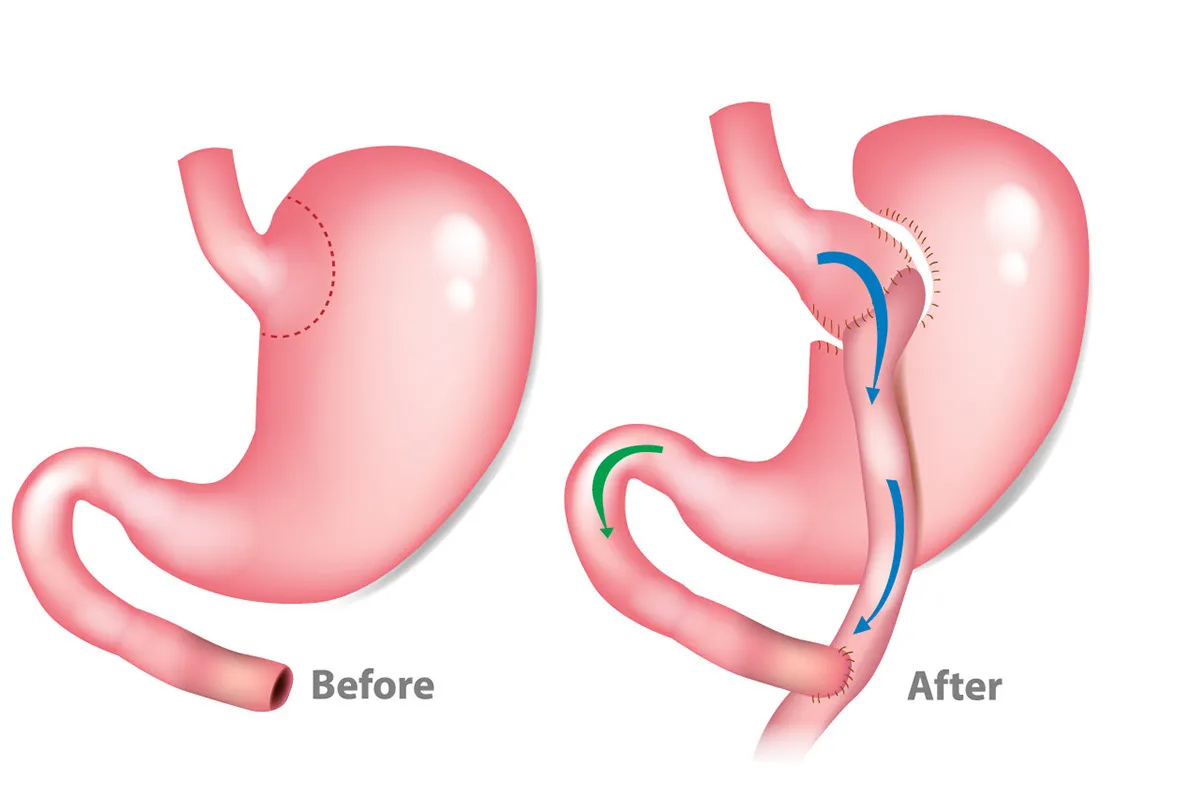 Gastric Bypass Surgery