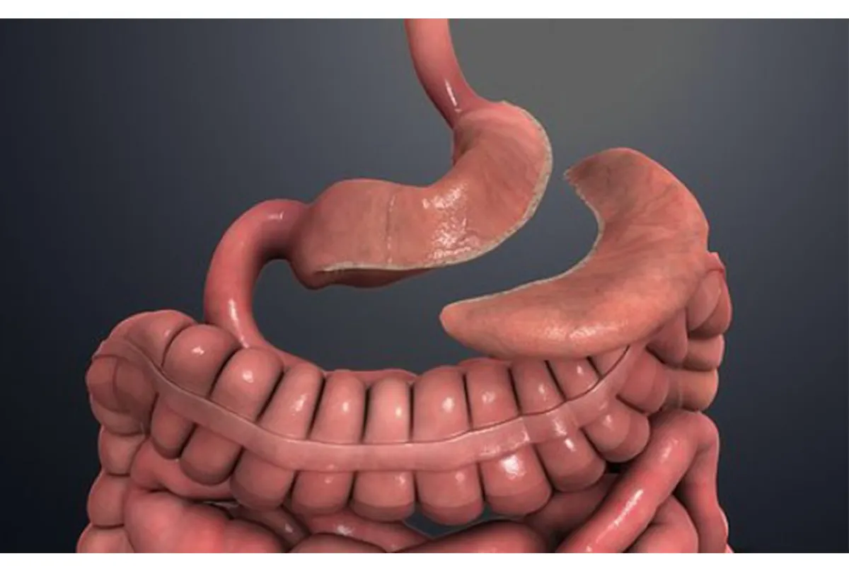 Mini Gastric Sleeve 10 Years Later
