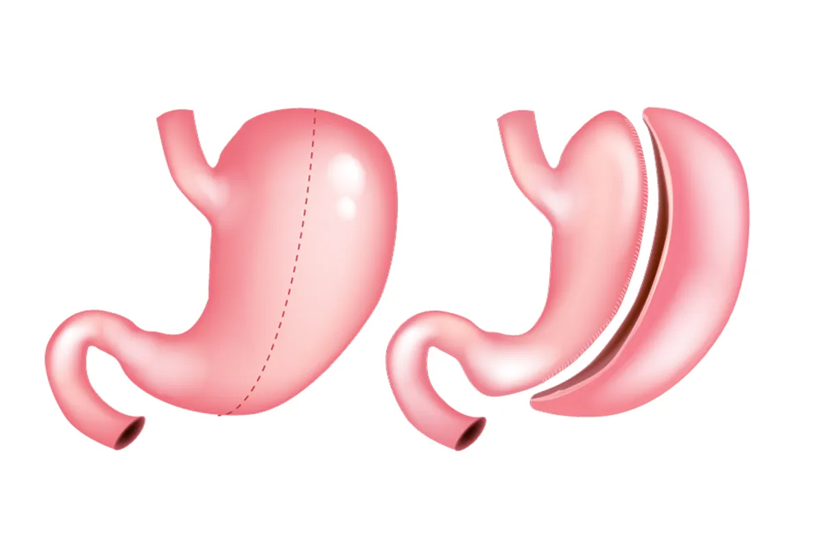 Mini Gastric Sleeve