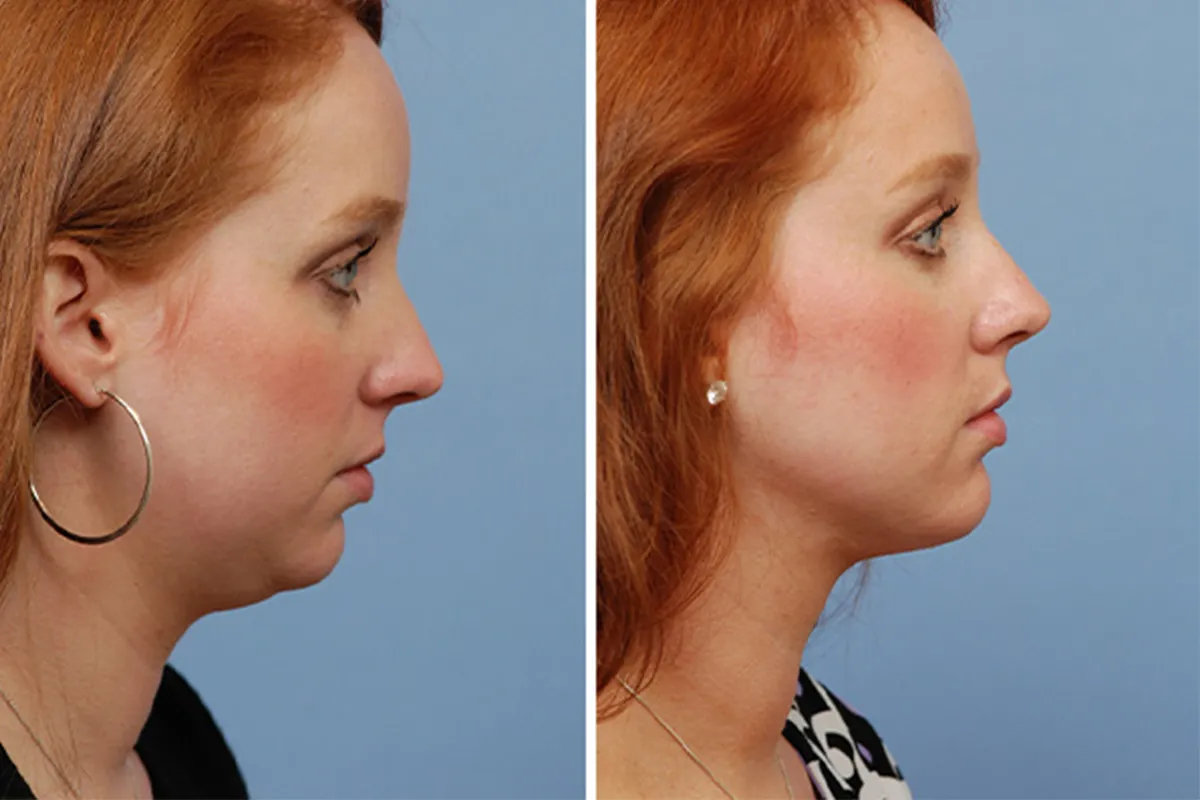 Neck Fat Removal