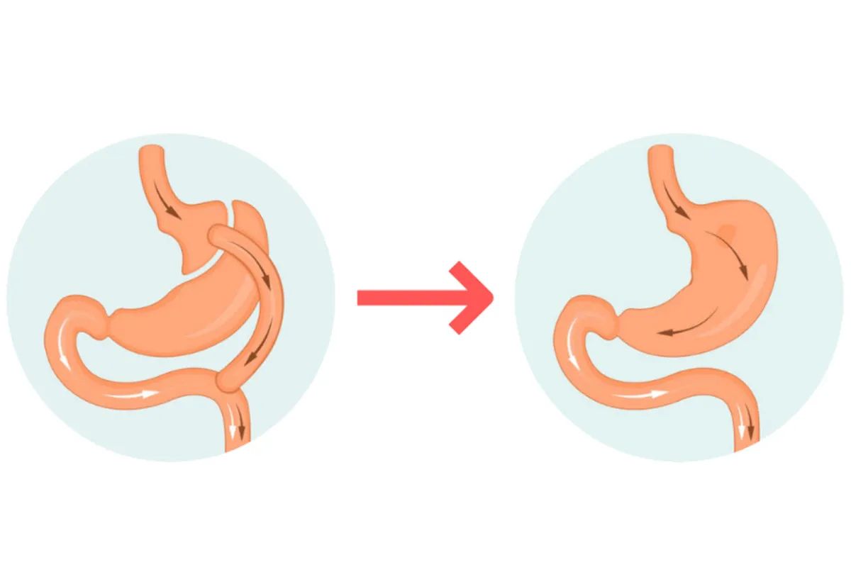 The Mini Gastric Sleeve Procedure