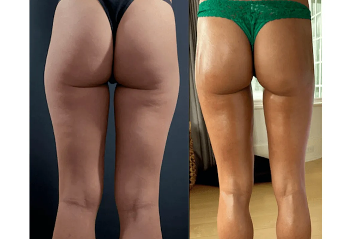 Thigh Liposuction