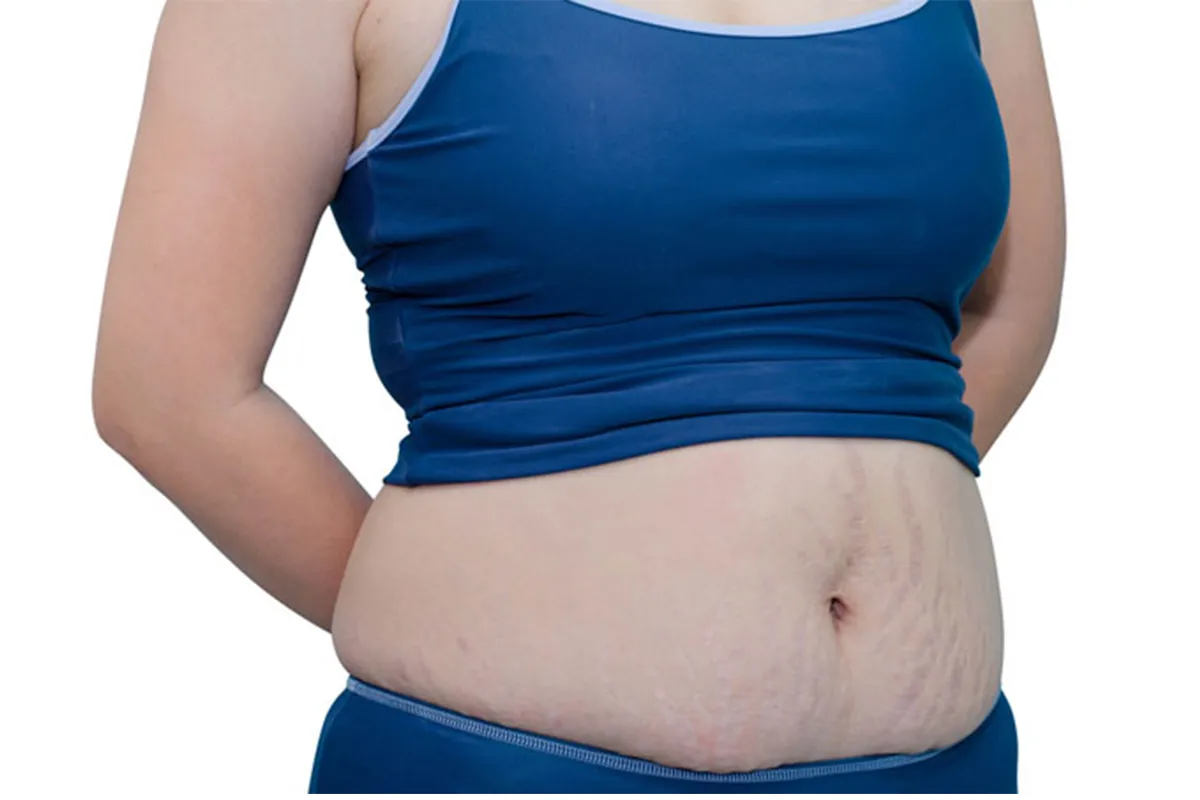 Weight Gain After Pregnancy